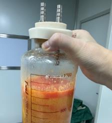 梨树县水动力吸脂手术要做多久？